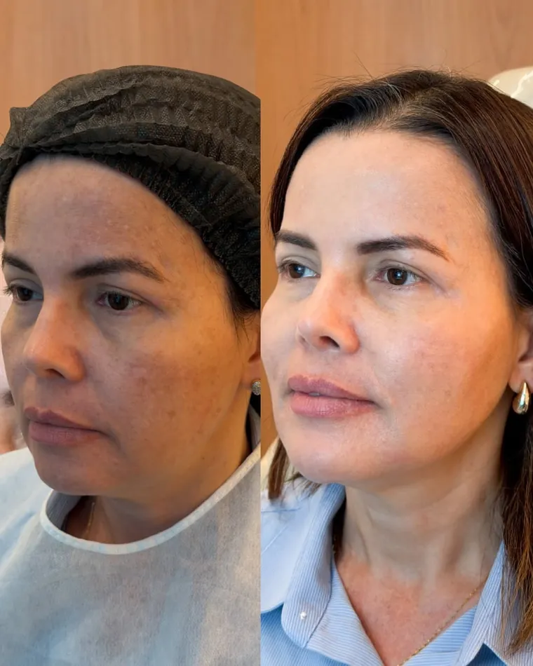 Antes e depois de rejuvenescimento facial sutil