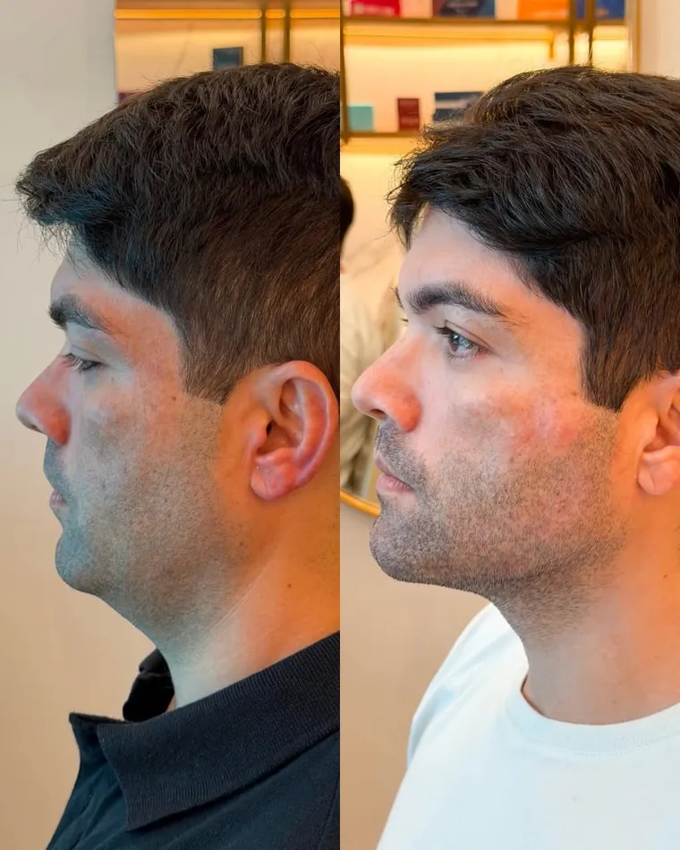 Antes e depois de definição de mandíbula em paciente masculino