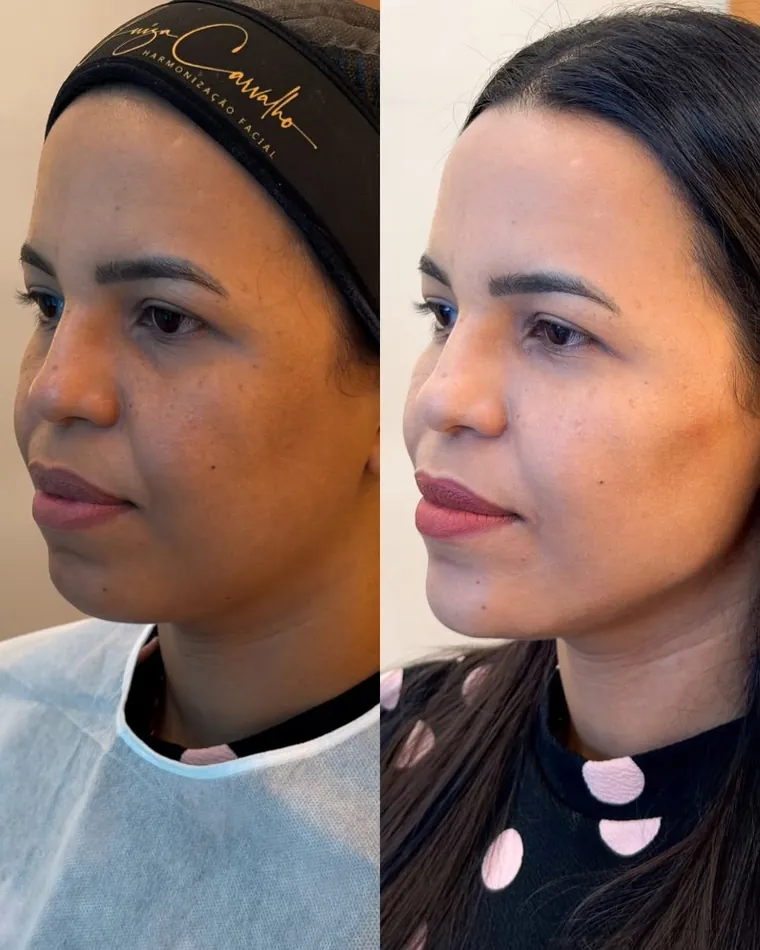 Antes e depois com reposicionamento de estruturas faciais