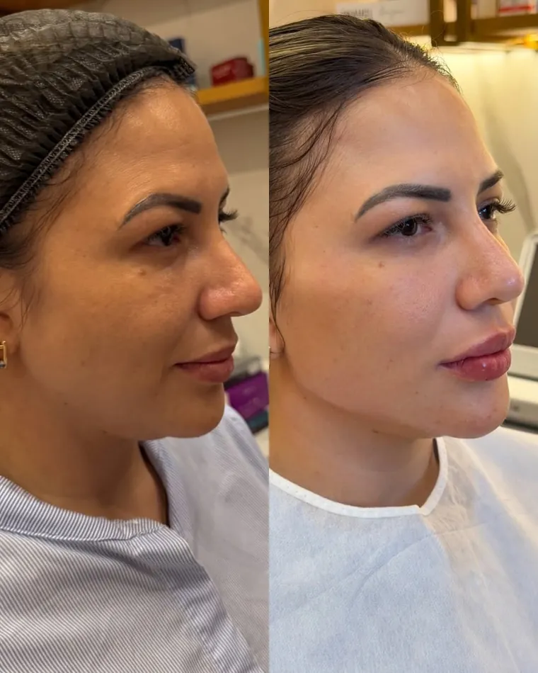 Antes e depois de tratamento de sustentação facial