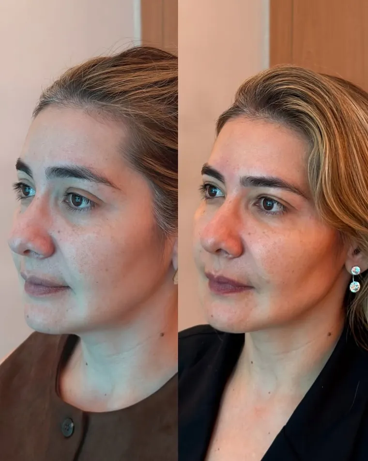 Antes e depois de harmonização facial natural